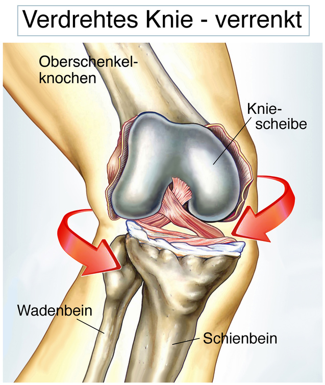 Verdrehtes Knie.Verrenkung. 